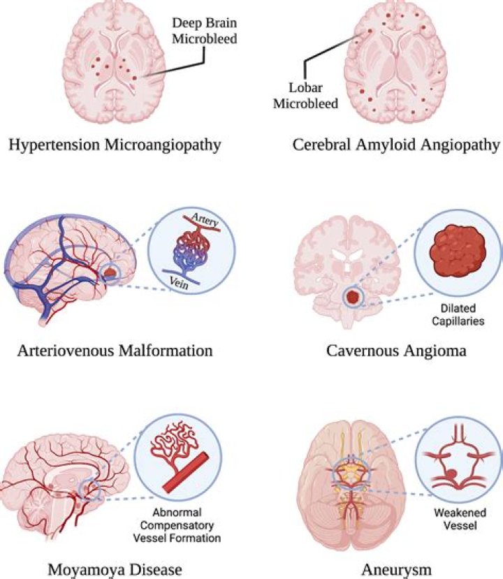 2022 AHA/ASA Guidelines for Managing Spontaneous Intracerebral Hemorrhage PDF