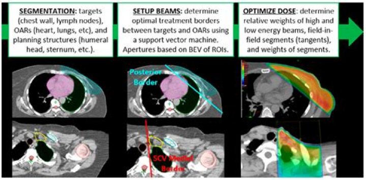 2D Radiotherapy Planning PDF: Accurate Treatment Design for Patients