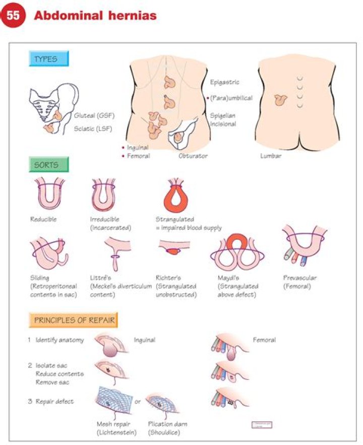 Abdominal Wall Hernias: Key Principles and Evidence-Based Management PDF