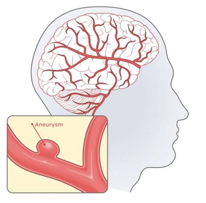 ACA Aneurysm Review PDF: Essential Management Guidelines & PDF Resources