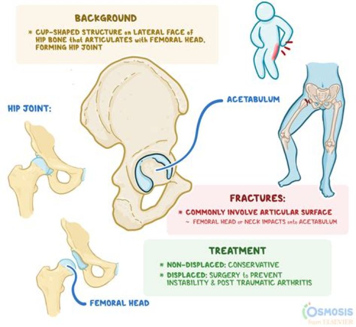Comprehensive Guide to Acetabular Fractures Management PDF