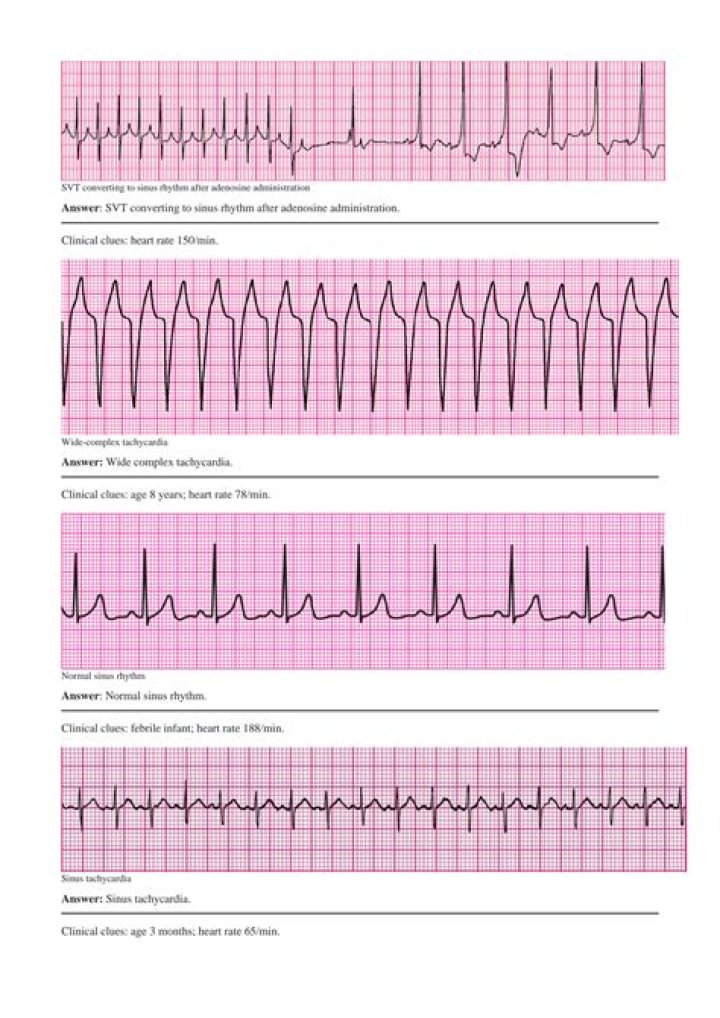 ACLS Rhythm Strips Answers PDF Quizlet – Master Emergency Care