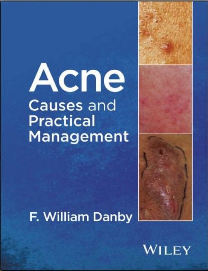 Acne Causes and Practical Management PDF – Expert Guide