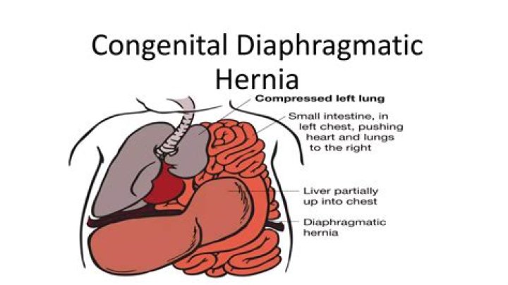 Anaesthesia Management for Congenital Diaphragmatic Hernia: Essential PDF Guidelines