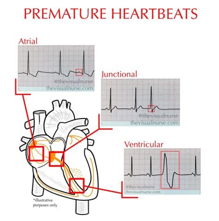 Are Premature beats normal?