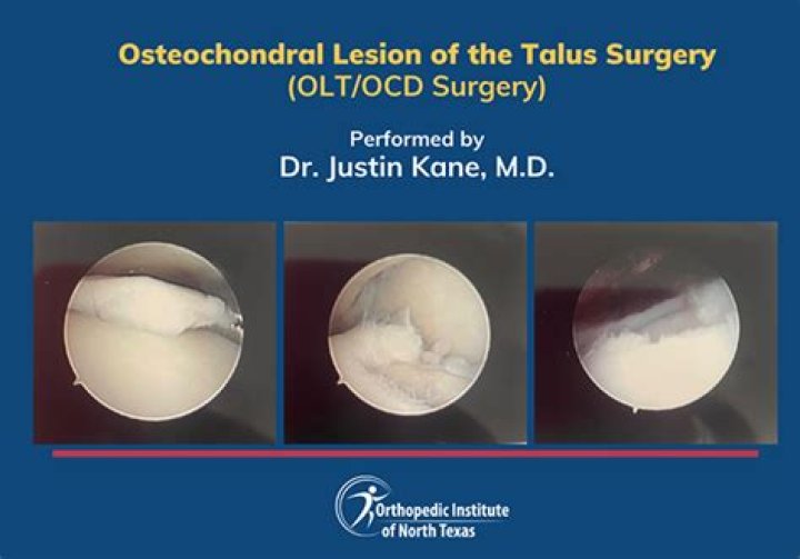 Arthroscopic Management of Osteochondral Defects of the Hip: Philippon’s Clinical Approach PDF