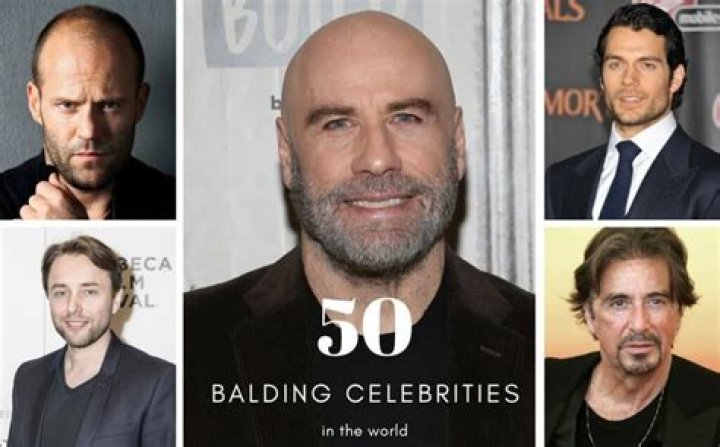 Bald Celebrities Famous People with Hair Loss