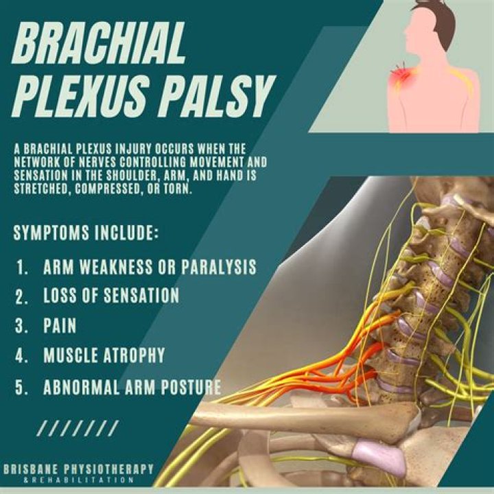 Brachial Plexus Injury Physiotherapy Management: Effective PDF Guide