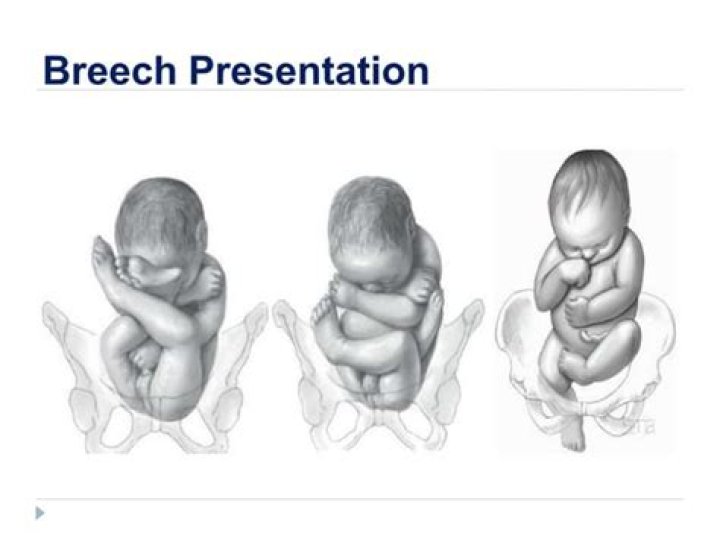 Breech Presentation Management PDF: Expert Guidelines & Treatment Protocols