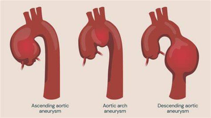 Can an aortic aneurysm be treated with medication?