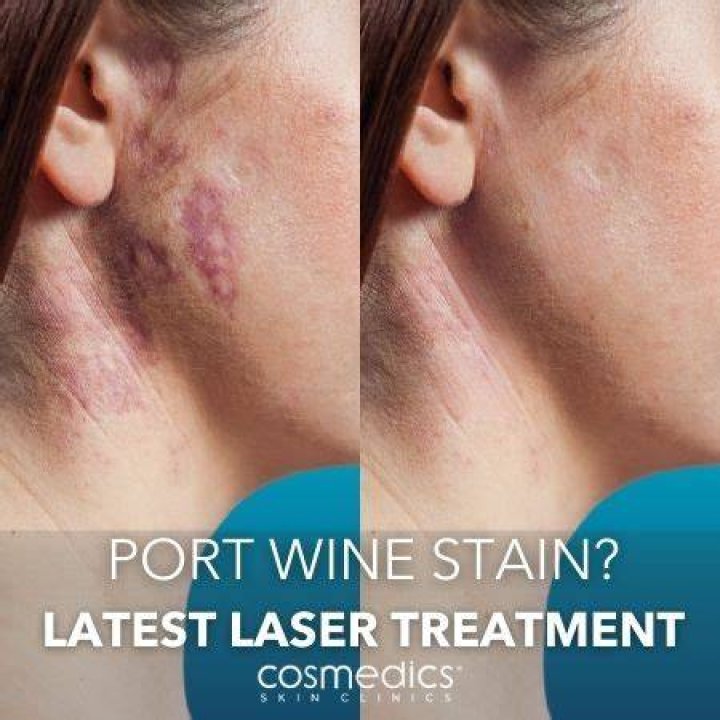 Can laser remove port-wine stains?