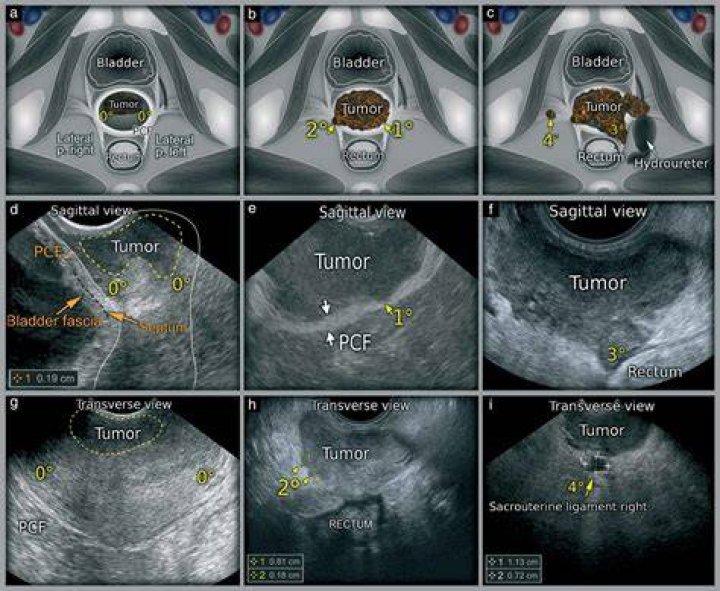 Can ultrasounds detect tumors?