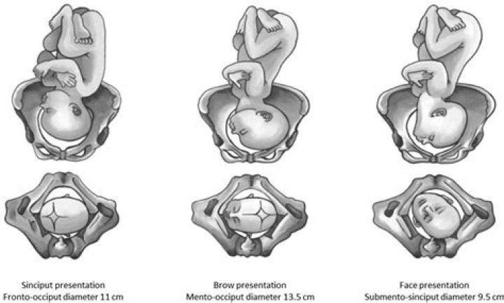 Cephalopelvic Disproportion Management PDF: Expert Clinical Guidelines