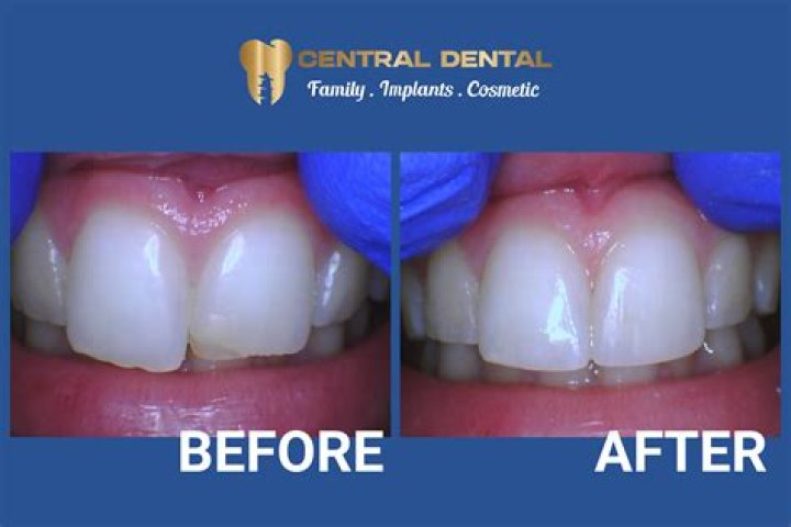 Chip Gaines Teeth Fixed Before And After TeethWalls