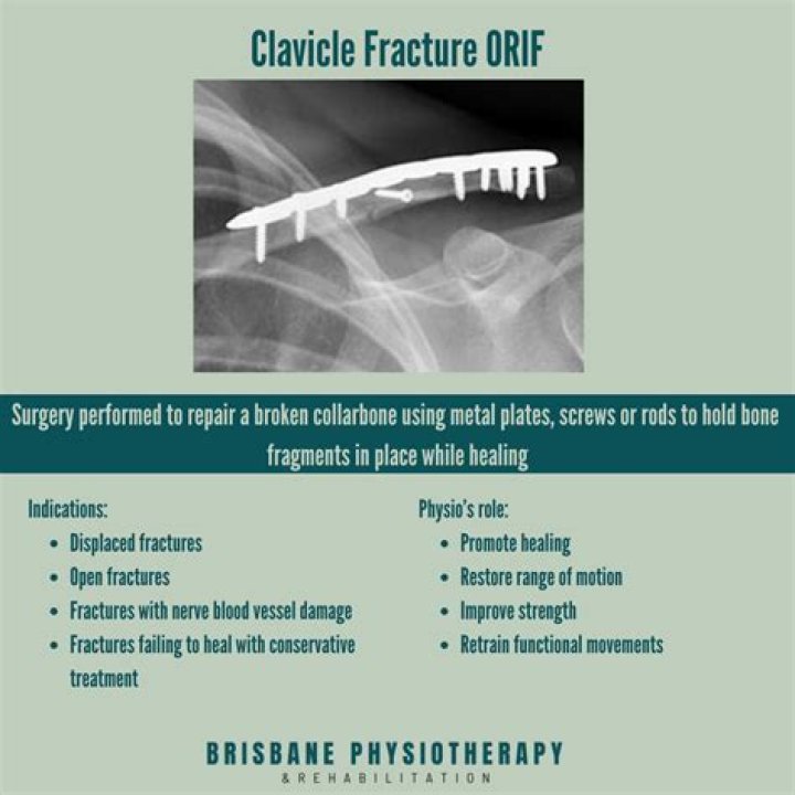 Clavicle Fracture Management PDF: Essential Treatment & Recovery Guide
