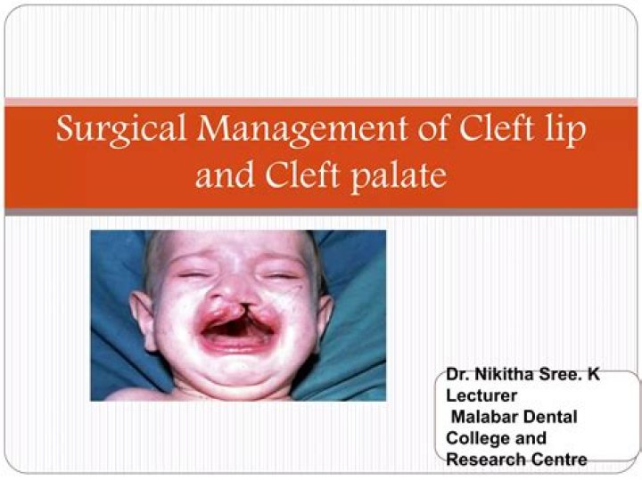 Comprehensive Guide to Cleft Lip and Palate Management PDF