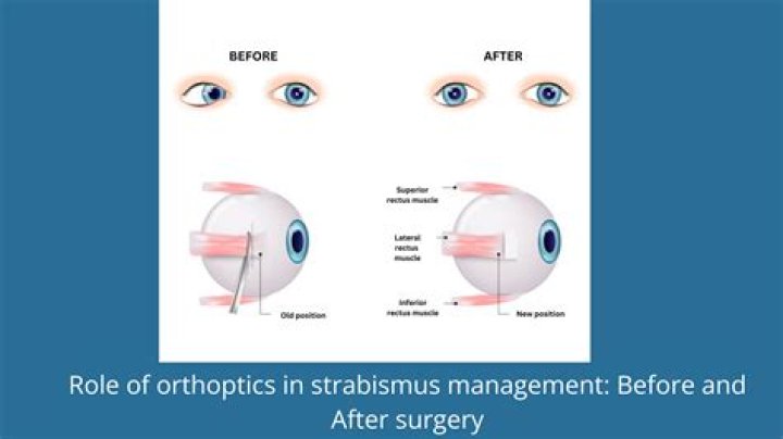 Clinical Strabismus Management: Principles and Surgical Techniques PDF Guide