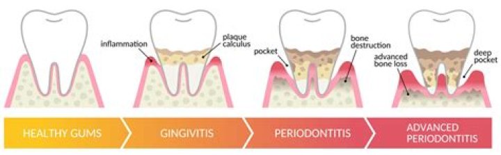 Clinical Success in Managing Advanced Periodontitis: A Comprehensive PDF Guide