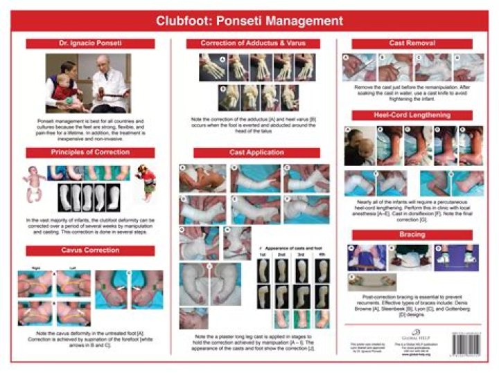 Complete Guide to Clubfoot Ponseti Management PDF for Parents and Clinicians