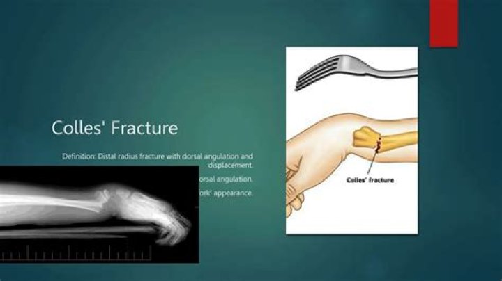 Comprehensive Colles Fracture Management Guide: Expert PDF