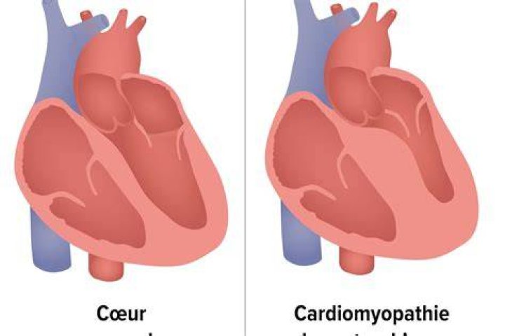 Comment se manifeste la cardiomyopathie de Becker?