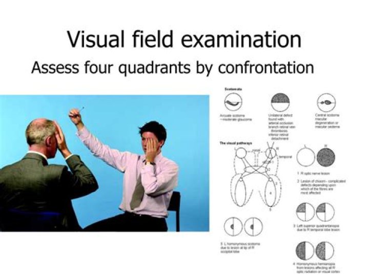 Confrontation Visual Field Test PDF: Essential Guide & Download