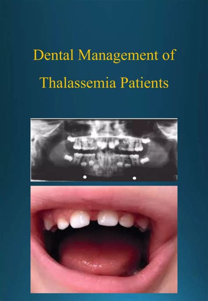 Dental Management of Thalassemia Patients: Essential PDF Guide
