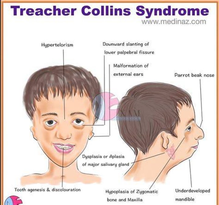 Do people with Treacher Collins syndrome have normal intelligence?