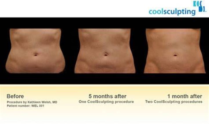 Does CoolSculpting work on beer belly?
