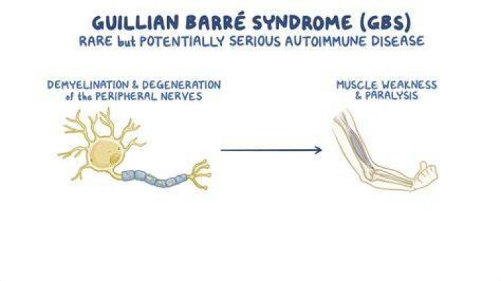 Does Guillain-Barre cause memory loss?
