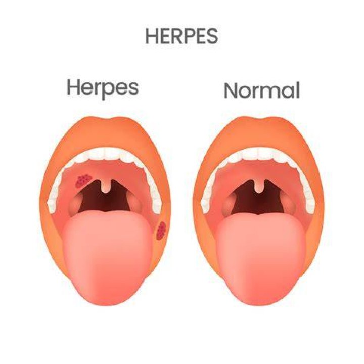 Does HSV-2 cause sore throat?