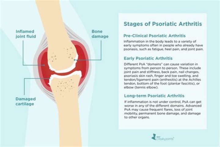 Does psoriatic arthritis destroy cartilage?