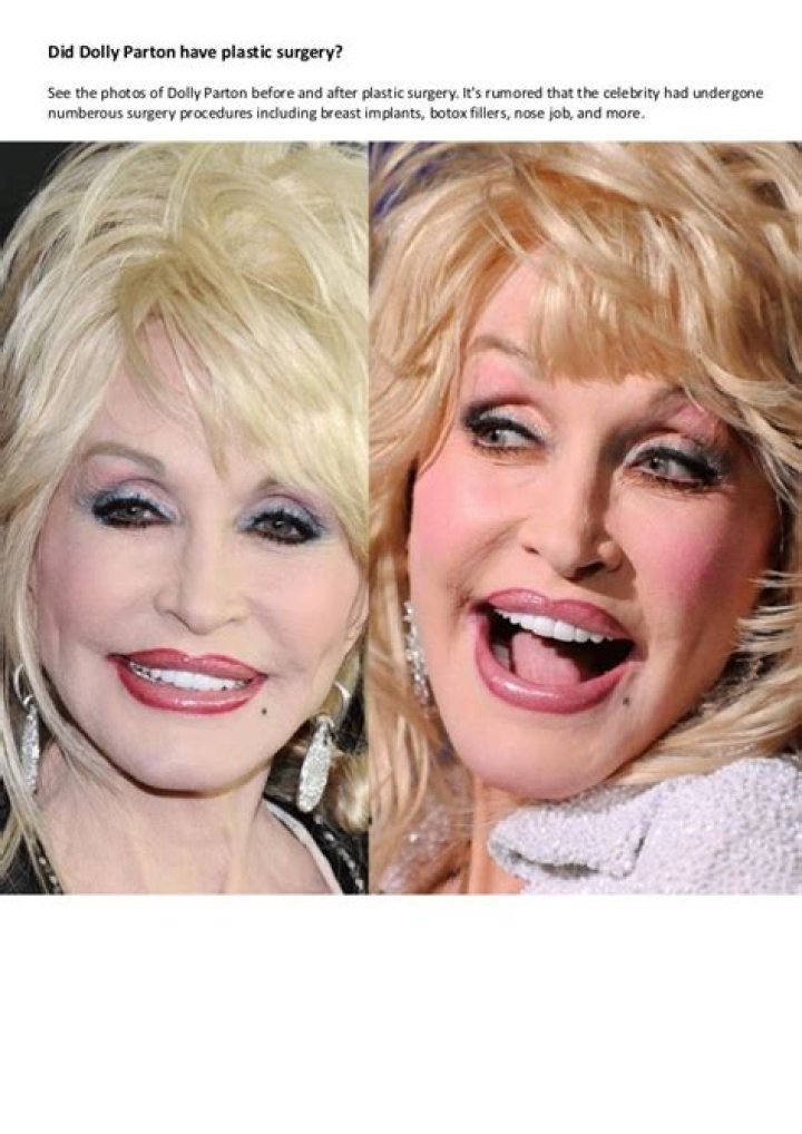 Dolly Parton Plastic Surgery Before & After Photos
