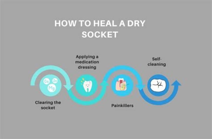 Dry Socket Management PDF: Essential Guide to Relief & Care