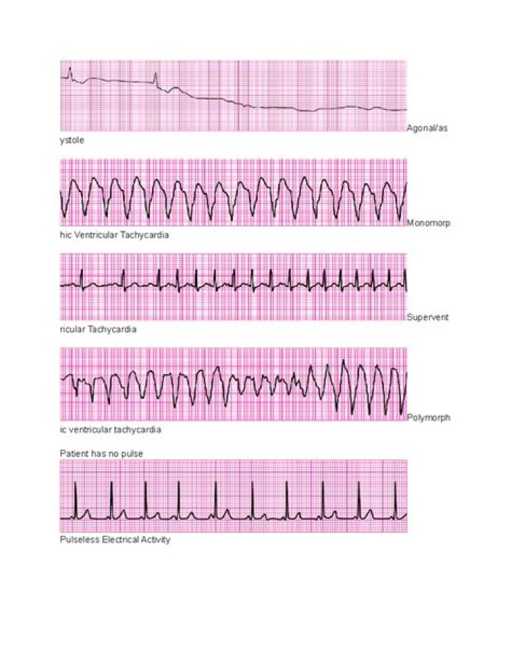 Effective ECG Workout Exercises for Arrhythmia Interpretation – Step-by-Step PDF Answers