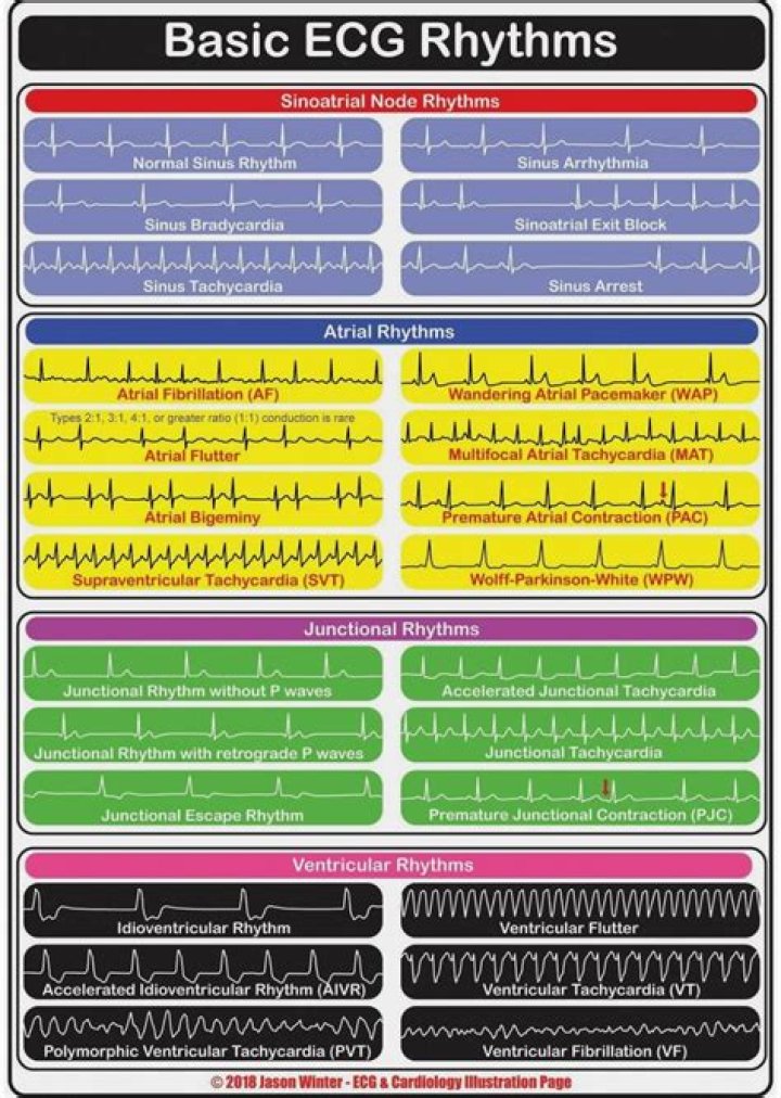 EKG Rhythms Cheat Sheet PDF – Quick Reference Guide