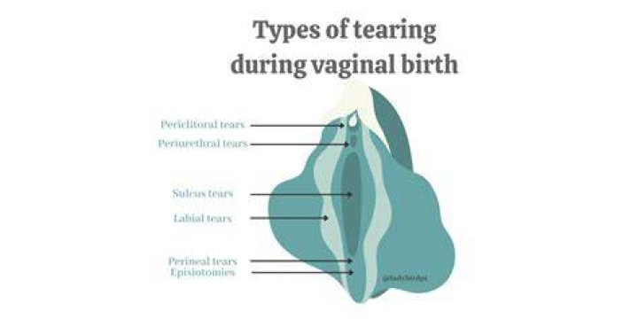 How common is a 4th degree tear during childbirth?