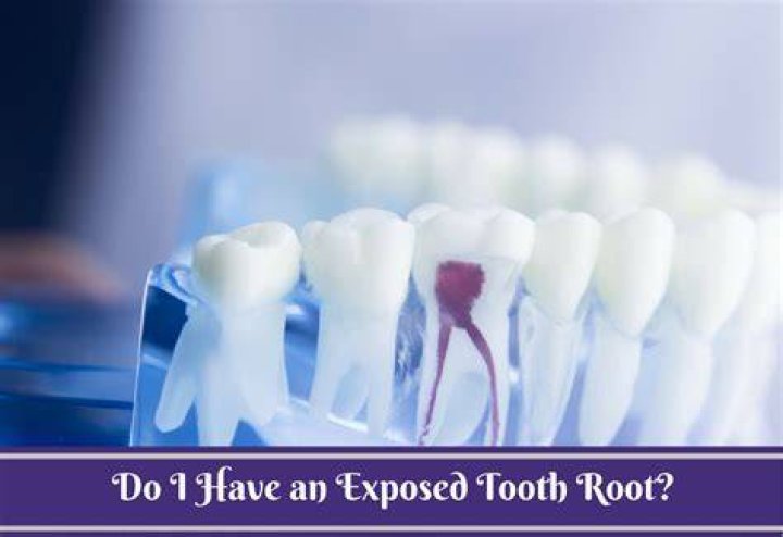 How do you treat an exposed tooth root?