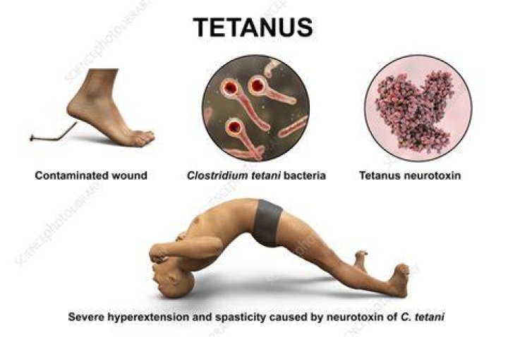 How do you treat tetanus pain?