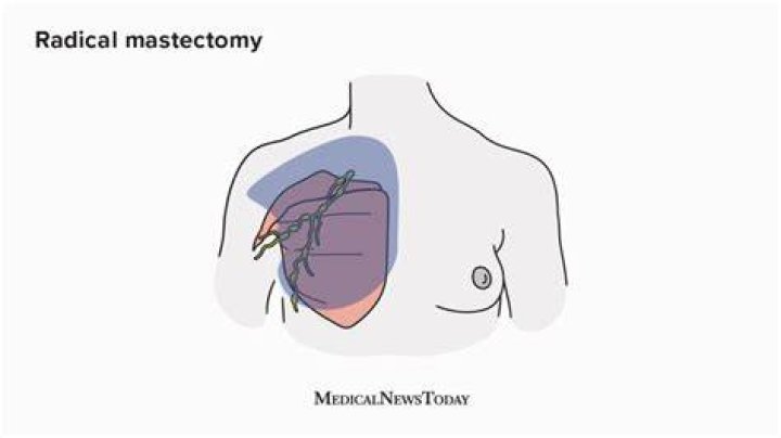How is a radical mastectomy performed?