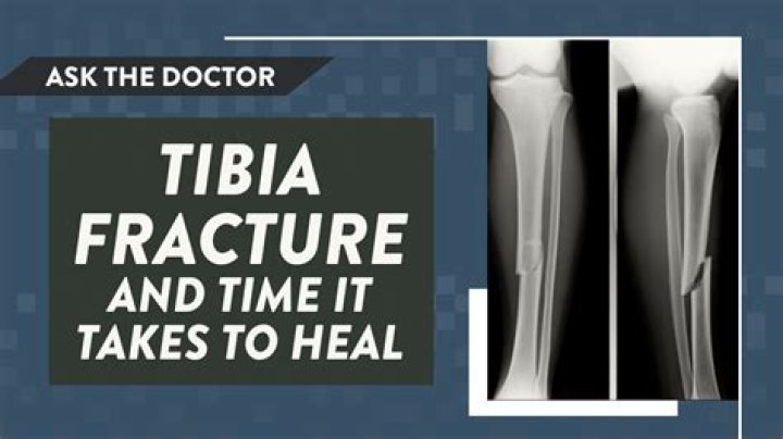 How long does it take for a tibia fracture to heal?