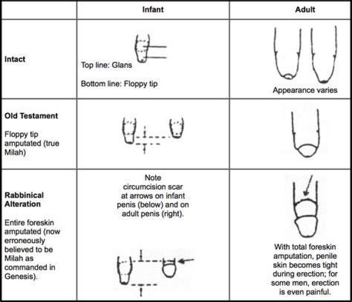 How many types of circumcision are there?