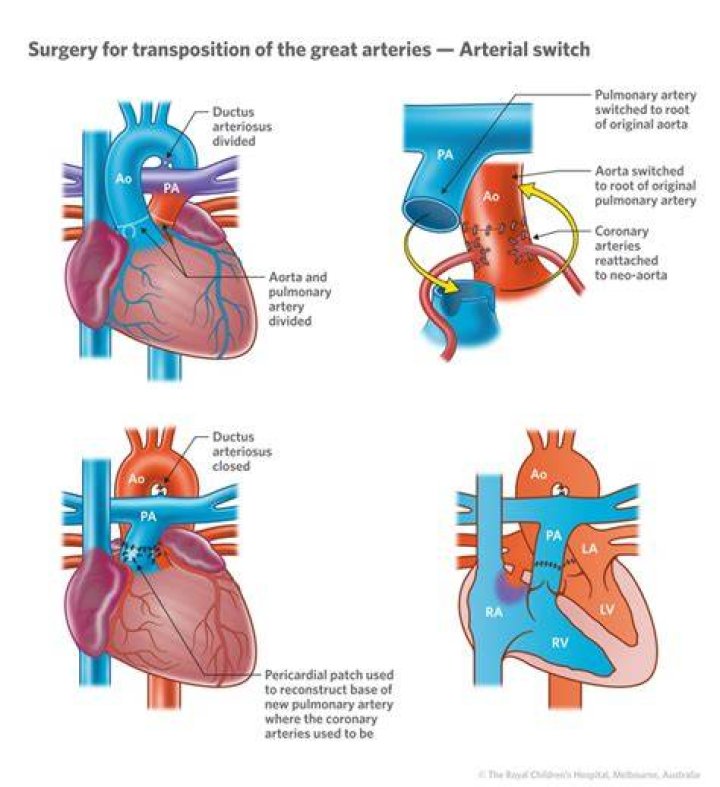 How rare is transposition of the great arteries?