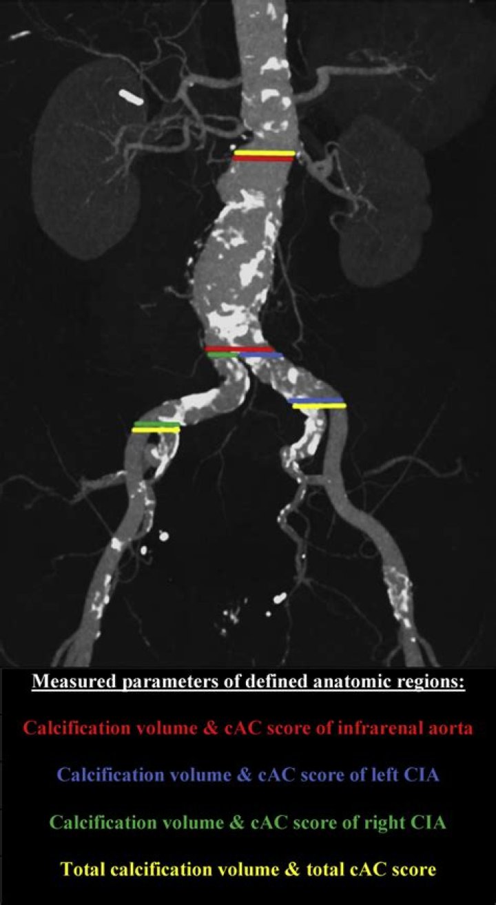 How serious is calcification of the abdominal aorta?