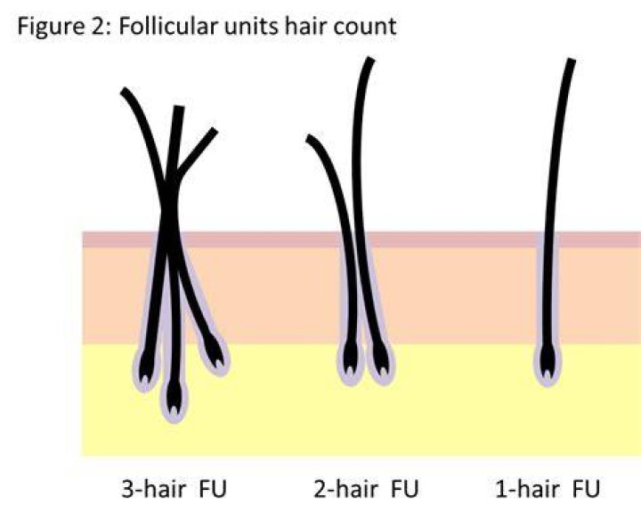 Is it normal to have two hairs one follicle?