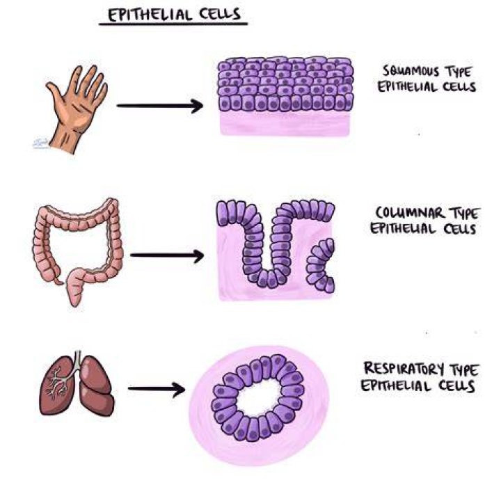 Is squamous epithelial cells cancer?