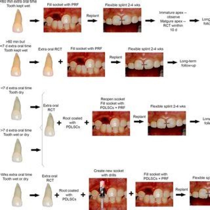 Comprehensive Management of Avulsed Tooth: Expert PDF Guide
