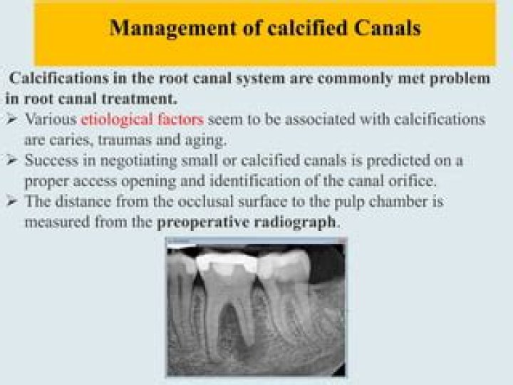 Management of Calcified Canals: A Comprehensive PDF Guide