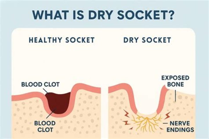 Complete Guide to Dry Socket Management PDF: Expert Care & Treatment Tips