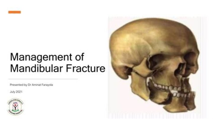 Comprehensive Guide to Management of Mandibular Fracture PDF
